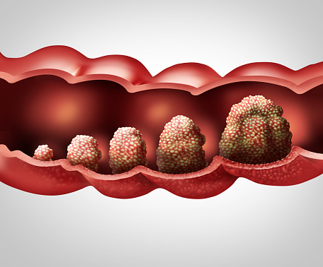 AHCI Grand Rounds - Updates in Colorectal Cancer Banner